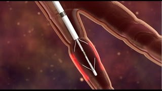 Bronchial Thermoplasty for Asthma [upl. by Kilk]