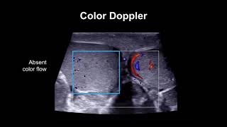 Diagnosing testicular torsion [upl. by Janeczka]