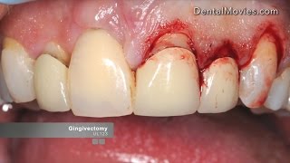 Crown lengthening  Satelec Piezotome 2 [upl. by Edijabab]