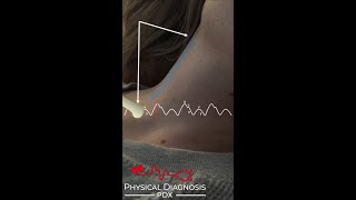 Normal Jugular Venous Pulse Narrated [upl. by Harri]