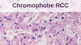 Chromophobe Renal Cell Carcinoma [upl. by Reynard]