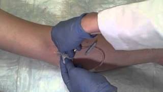 Intravenous IV Catheter Removal [upl. by Norrad166]