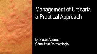 Diagnostic testing and chronic urticaria  Choosing Wisely [upl. by Zachary650]