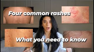 Four common rashes and everything you need to know about them [upl. by Tedmann918]