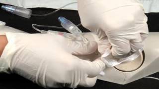 Chapter 8  PICC Catheter Removal [upl. by Clara]