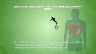 Endoscopic Retrograde Cholangiopancreatography ERCP [upl. by Alenoel983]