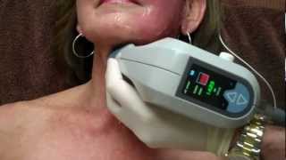 Exilis on Face amp Neck for Skin Tightening with Dr Seiler [upl. by Pieter]