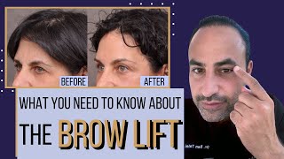 What You Need To Know About The Brow Lift  Dr Ben Talei Beverly Hills Los Angeles [upl. by Giustina128]