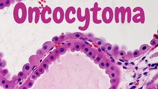 Renal Oncocytoma  Pathology mini tutorial [upl. by Ydeh]