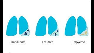 How to recognize different pleural effusions on chest CT [upl. by Kent]