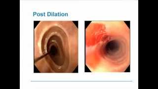 Eosinophilic Esophagitis [upl. by Barhos]