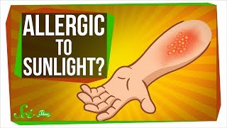 Urticaria Hives and Angioedema – Pediatrics  Lecturio [upl. by Notterb]