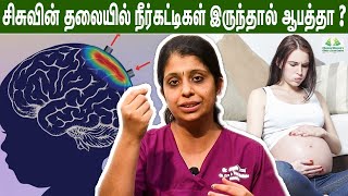 சீறுநீர் தேக்கம் குழந்தையின் kidney யில் இருந்தால் பாதிப்பு ஏற்படுமா   Dr Deepthi Jammi  Cwc [upl. by Lavinia]