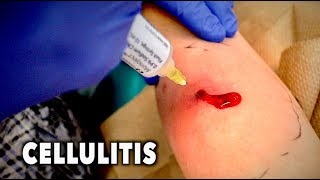 ABSCESS WITH CELLULITIS We had to drain it  Dr Paul [upl. by Colvin]