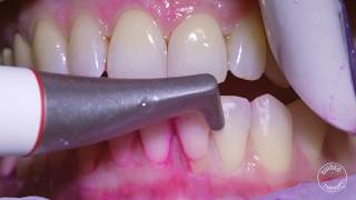 How teeth should be cleaned at the Dentist  Hygienist [upl. by Mercer]