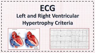 Left and Right Ventricular Hypertrophy ECG criteria  LVH  RVH  ECG  Simplified [upl. by Ettenom113]