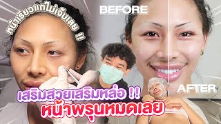 VLOG 211 หิวเข็มอีกแล้วหน้าพรุนมาก  ครั้งแรกกับการยกกระชับหน้าด้วยเครื่อง Ulthera ดีจริงหรอ [upl. by Iredale]