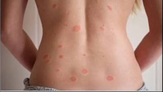 Pityriasis Rosea [upl. by Aviv]