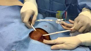 Tunneled Dialysis Catheter Insertion [upl. by Nylde389]