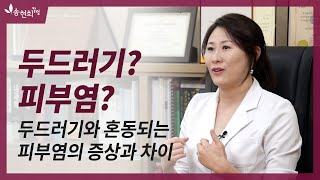 두드러기성 혈관염  두드러기로 오인하기 쉬운 두드러기성 혈관염 [upl. by Kopaz146]