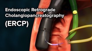 upper gastrointestinal endoscopy procedure [upl. by Notterb522]