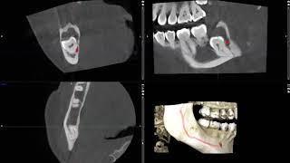 cyst or tumor in the jaw unknown lesion imaged on CBCT [upl. by Cordi]