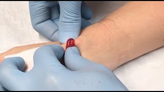 ganglion cyst drainage [upl. by Sivrup]