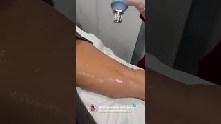 EXILIS ULTRA 360 [upl. by Akinet335]