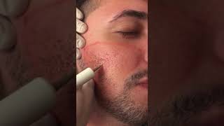 Tratamento de cicatrizes de acne com jato de plasma [upl. by Enitselec842]