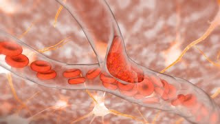 Ischemic Stroke [upl. by Marya]