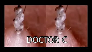 REMOVING INFECTED INGROWN HAIR 15 [upl. by Strawn689]