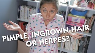 Pimple Ingrown Hair or Herpes [upl. by Eceirtal]