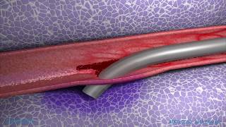 Peripheral IV Infiltration Animation [upl. by Tnert]