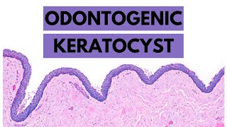 Odontogenic Keratocyst Clinical features Radiology Histology and Treatment [upl. by Yraccaz]