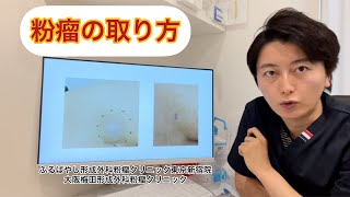 粉瘤の取り方 切開法 くりぬき法 ブログでも詳しく解説してます。 東京皮膚のできものと粉瘤クリニック ふるばやし形成外科新宿院 大阪梅田形成外科クリニック [upl. by Janina624]