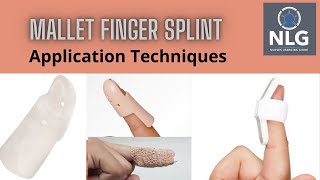 Mallet finger splint applicationeasy application technique [upl. by Sib646]