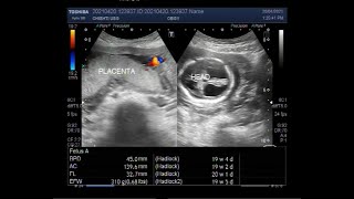 Dilated ventricles with a pregnancy of about 19 to 20 weeks [upl. by Hutson325]