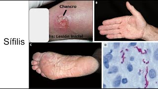 Sífilis Etapas de la infección diagnóstico y tratamiento [upl. by Noam]