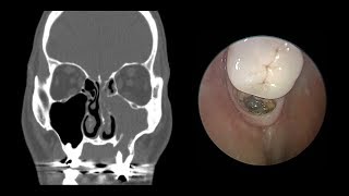 Odontogenic Sinusitis Sinus Surgery First [upl. by Nohsal]