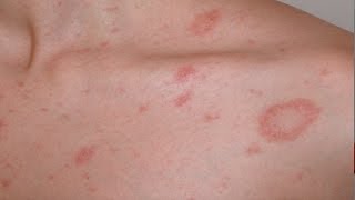 Pityriasis rosea English version [upl. by Ramahs186]