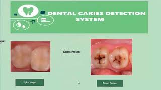 Dental Caries Detection System [upl. by Ahsercal]