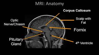 Normal Brain MRI Anatomy  Neuroradiology Made simple [upl. by Mag]