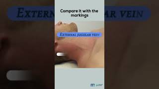 Examination of Jugular Venous Pulse [upl. by Tiny]