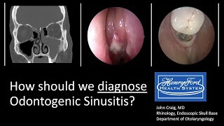 Diagnosing Odontogenic Sinusitis International Consensus [upl. by Pinelli]