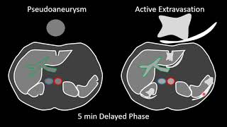 Extravasation  IV Infiltration Errors Explained Doctor Interview [upl. by Suoinuj]