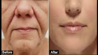 HOW TO REMOVE DEEP MOUTH WRINKLES REALLY FAST [upl. by Solram]