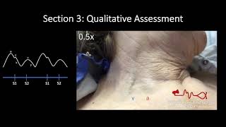 Jugular Venous Pulse Qualitative Assessment [upl. by Ahsinan361]