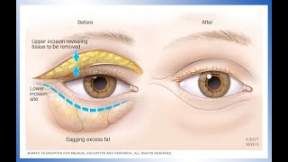 Brow Lift Masseter Frontalis and Glabella Botox Treatment  AAFE [upl. by Flowers685]