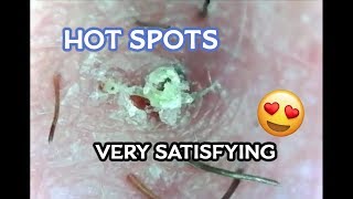 Satisfying quotHot Spotsquot Concentrated Ingrown Hairs Microscopic [upl. by Anohsal]