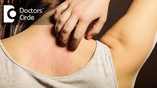 What Causes Hives and Itchiness  Urticaria Hives Treatment  Dr Berg [upl. by Kristie]